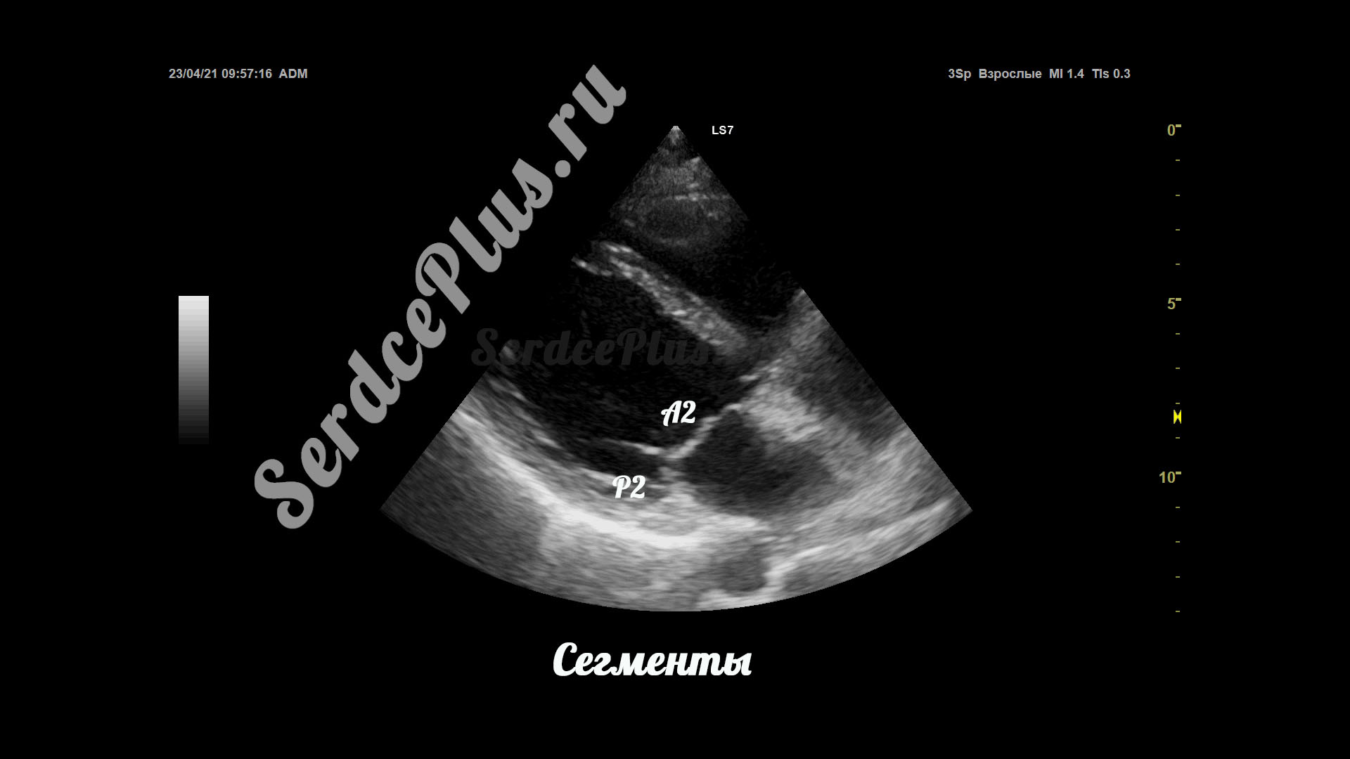 Створки и сегменты митрального клапана на ЭхоКГ