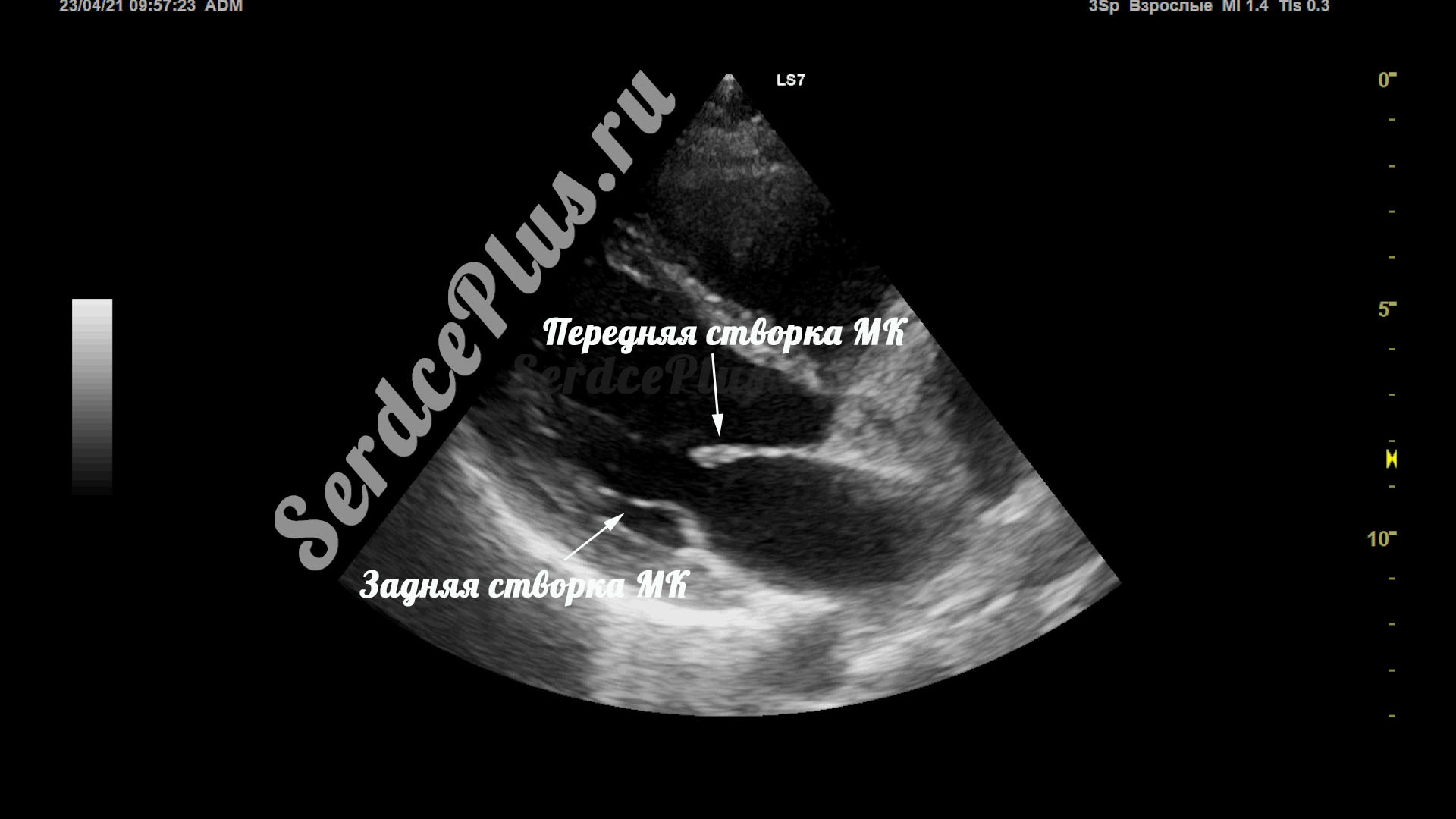 Створки и сегменты митрального клапана на ЭхоКГ