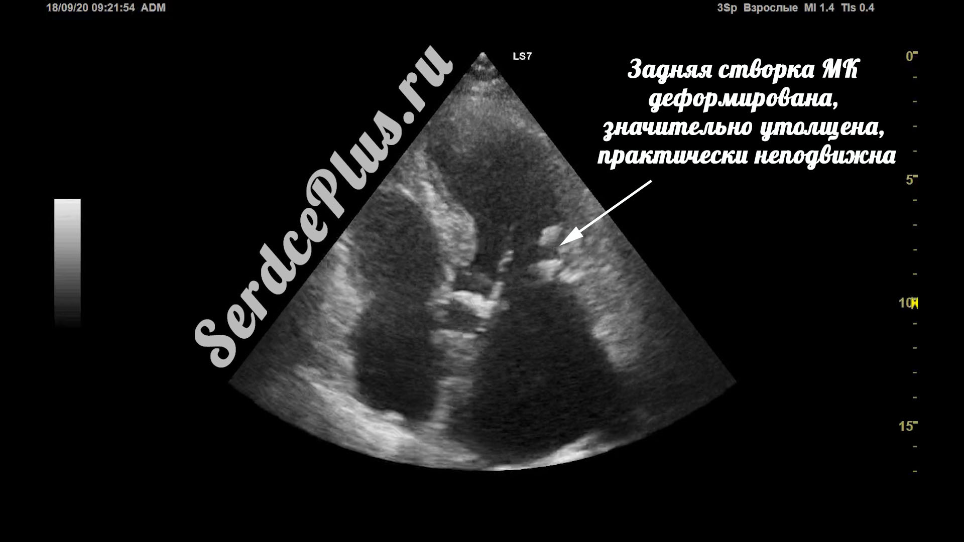 Митральный стеноз 2 степени на эхокардиографии
