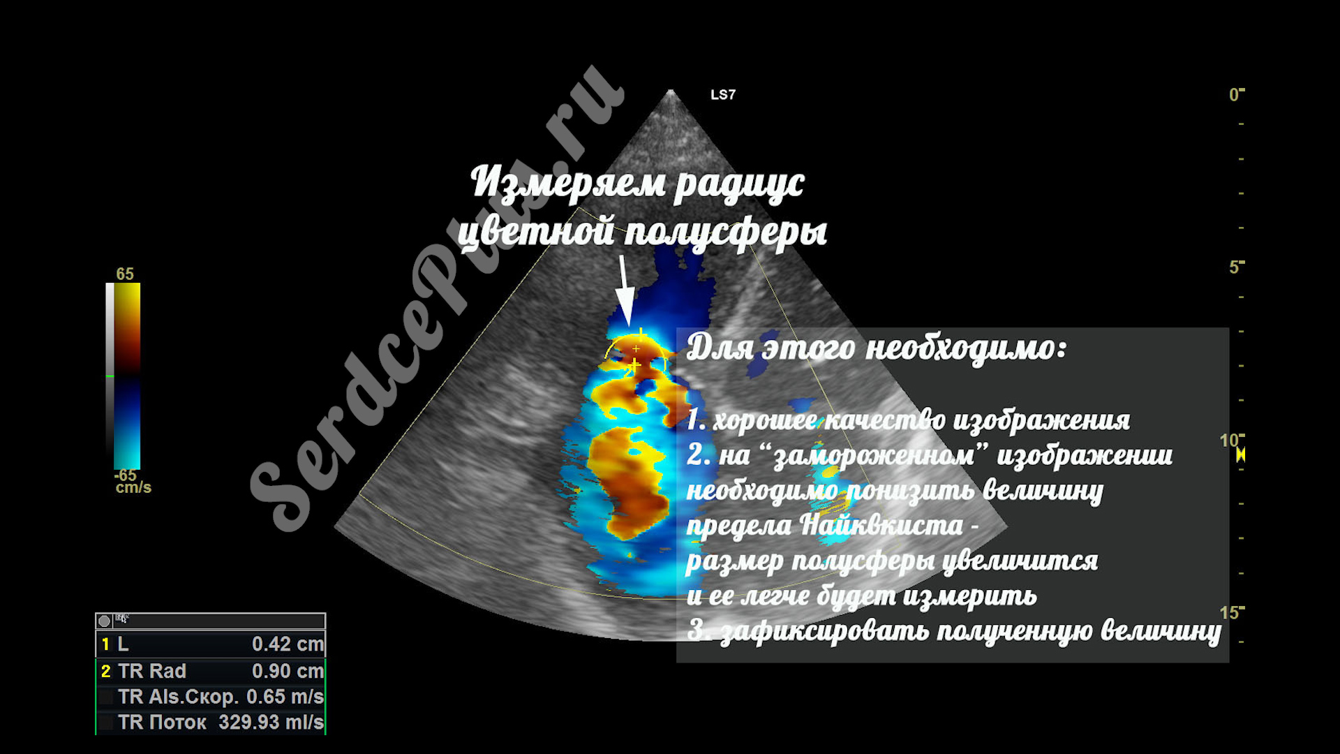 Измерение клапанной недостаточности по методу PISA
