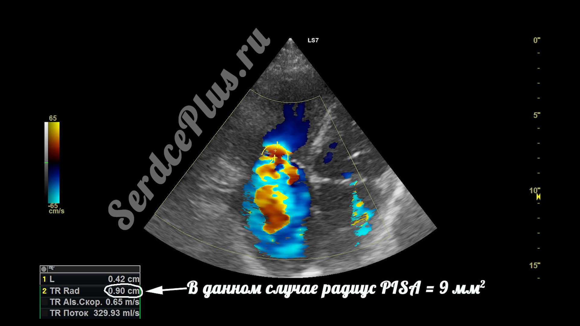 Измерение клапанной недостаточности по методу PISA