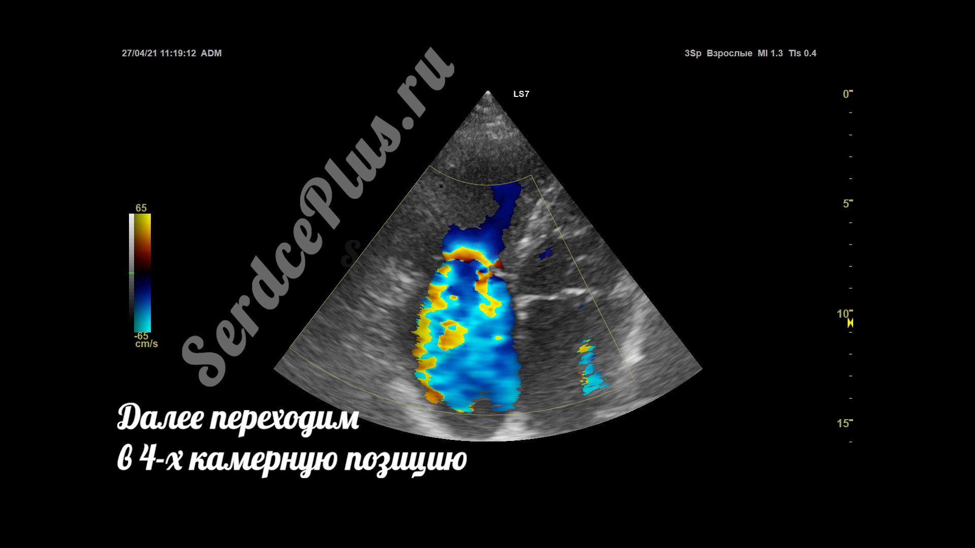 Измерение клапанной недостаточности по методу PISA
