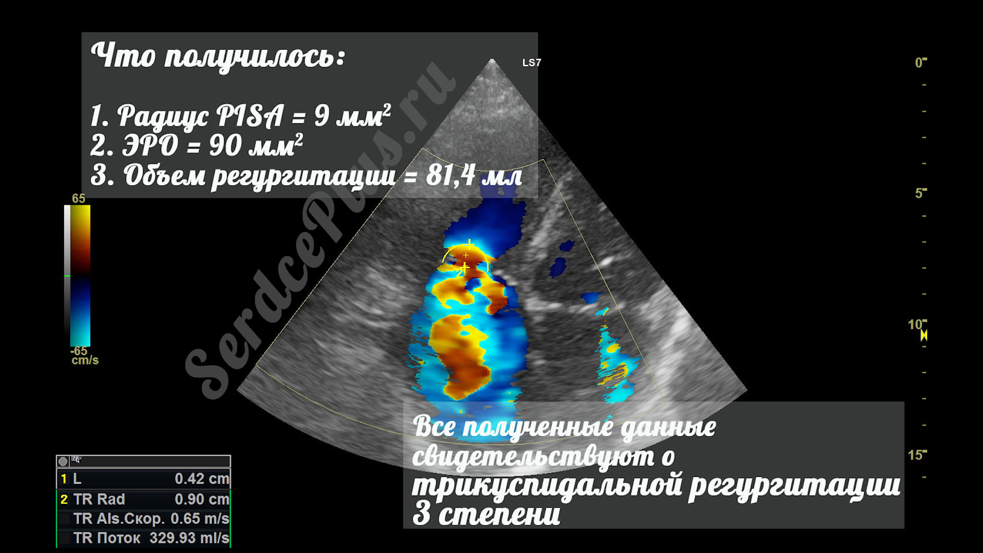Измерение клапанной недостаточности по методу PISA