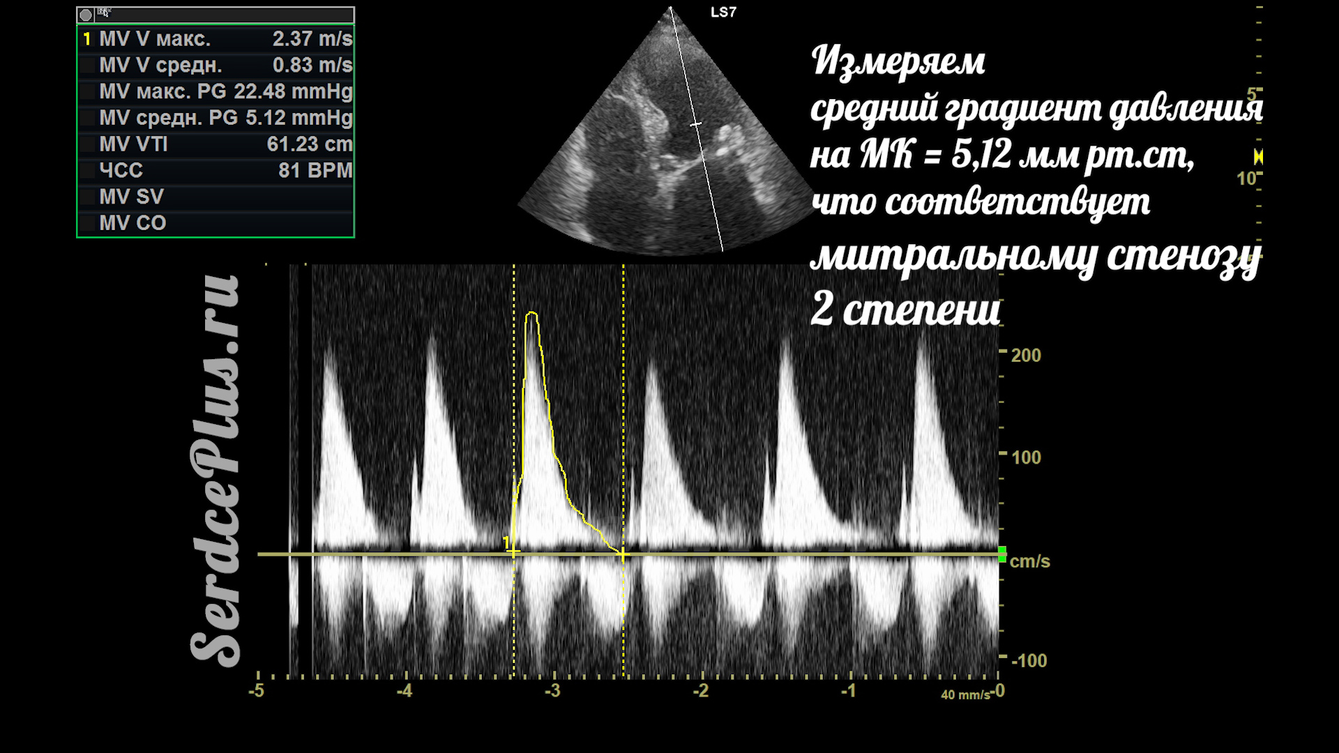 Митральный стеноз 2 степени на эхокардиографии
