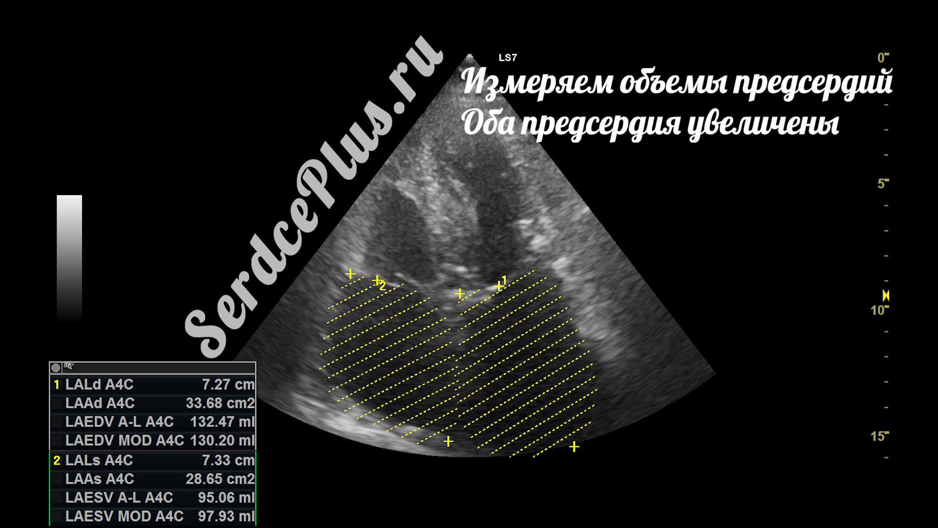 Митральный стеноз 2 степени на эхокардиографии