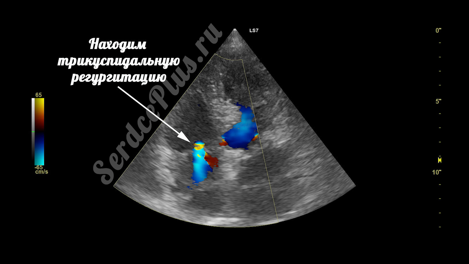 Митральный стеноз 2 степени на эхокардиографии