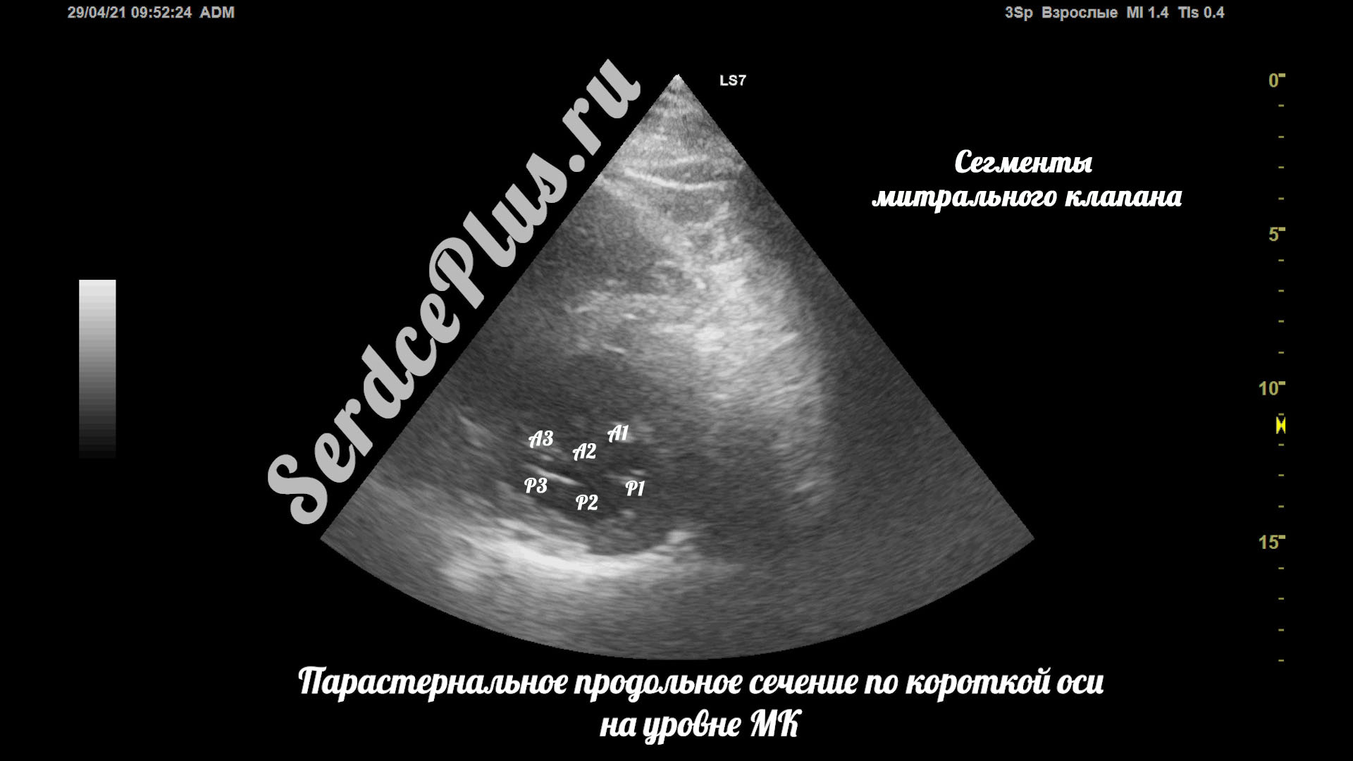 Частичный отрыв хорд митрального клапана на эхокардиографии
