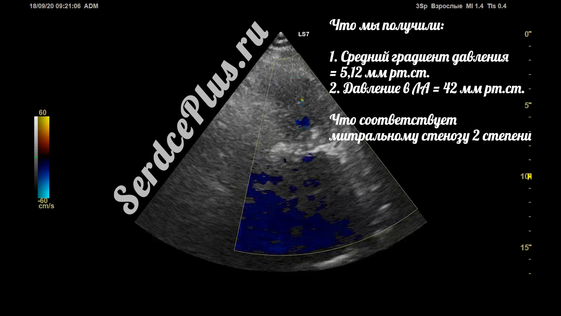 Митральный стеноз 2 степени на эхокардиографии