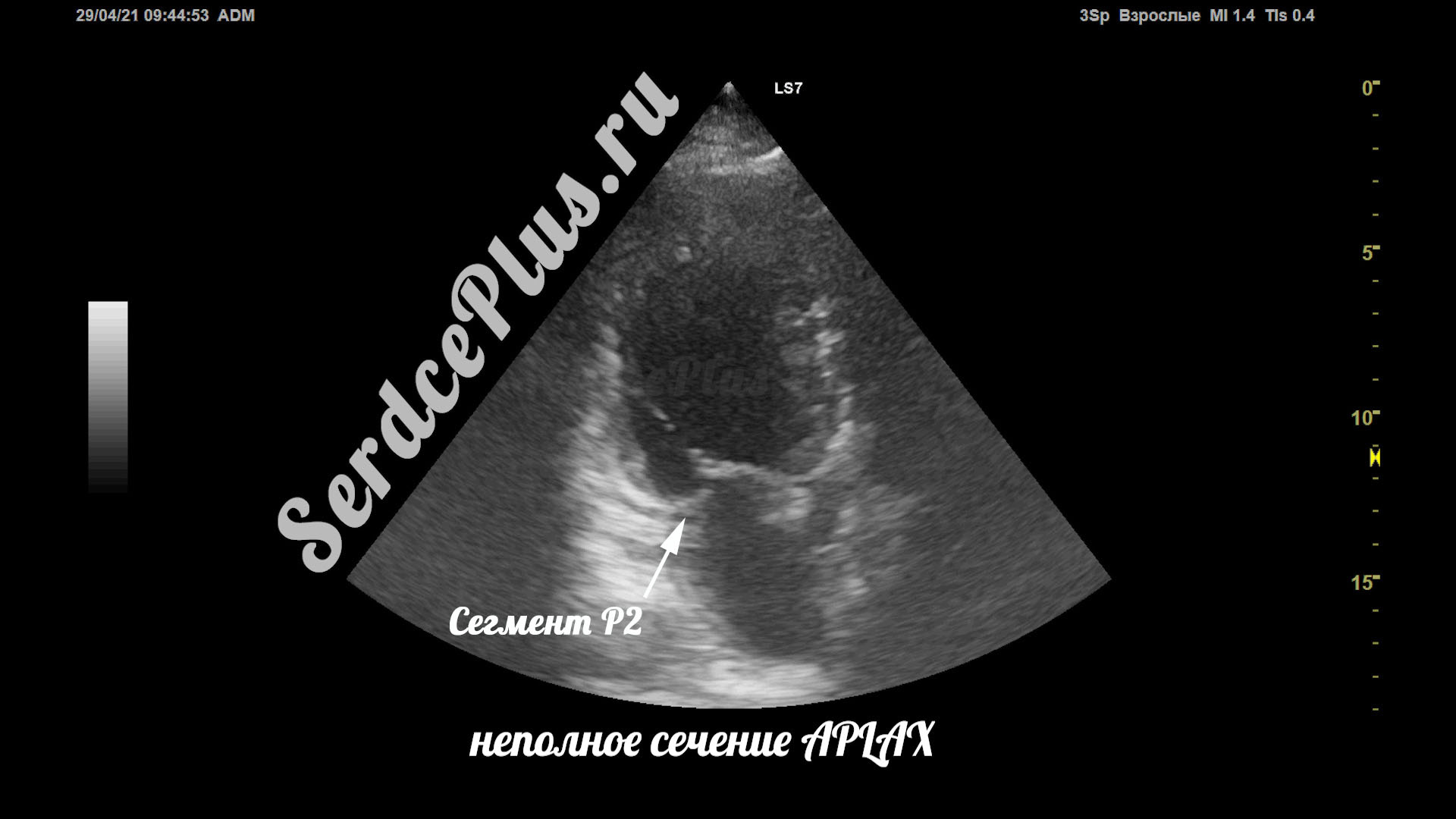 Частичный отрыв хорд митрального клапана на эхокардиографии