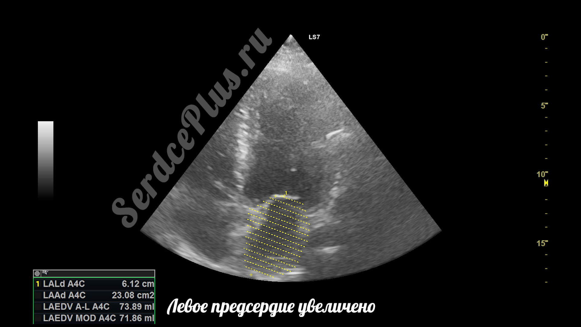 Частичный отрыв хорд митрального клапана на эхокардиографии