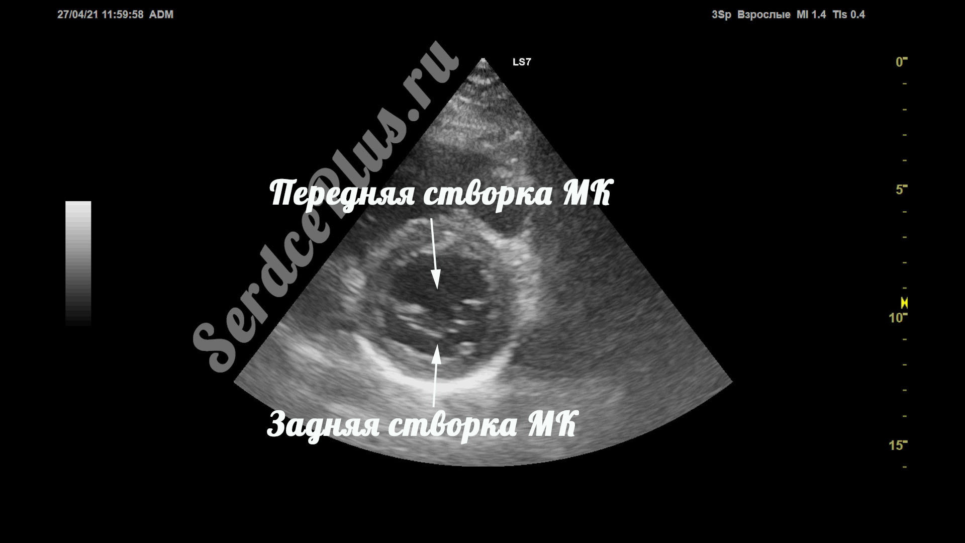 Створки и сегменты митрального клапана на ЭхоКГ