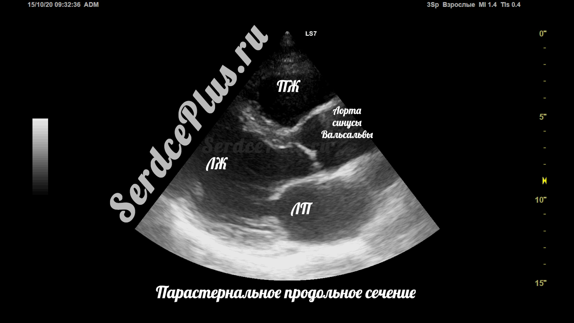 Сечения в эхокардиографии