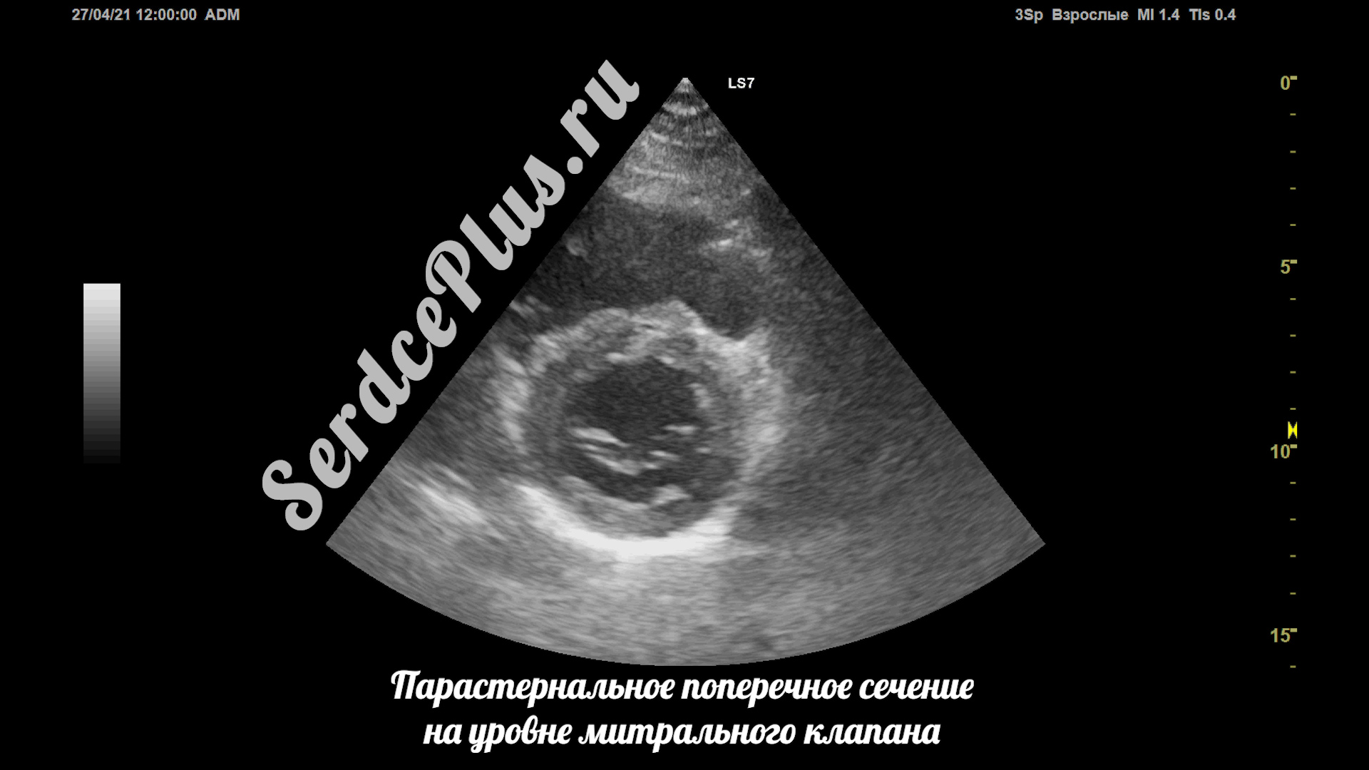 Сечения в эхокардиографии