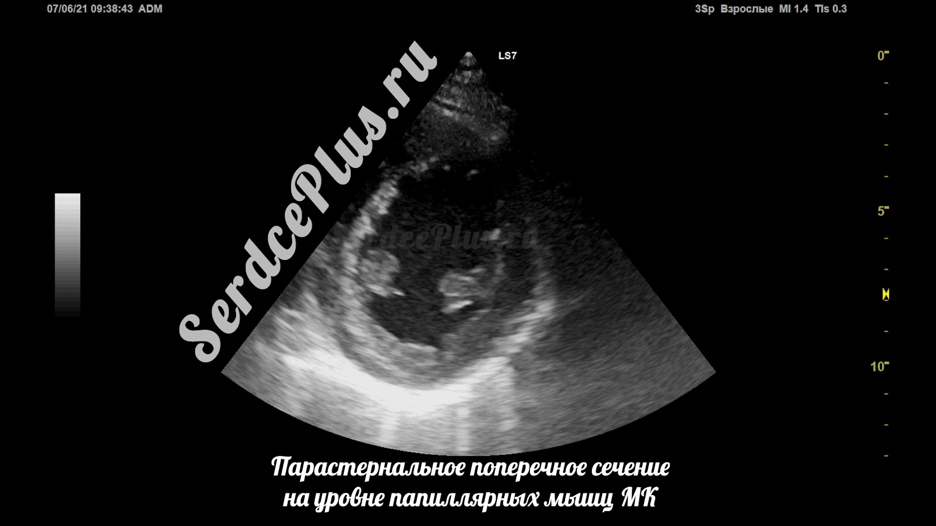 Сечения в эхокардиографии