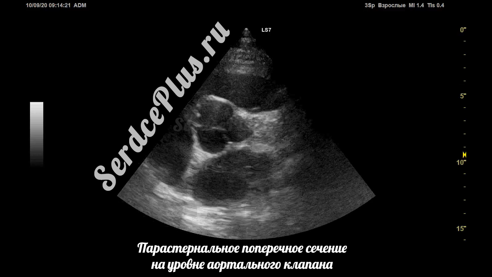 Сечения в эхокардиографии