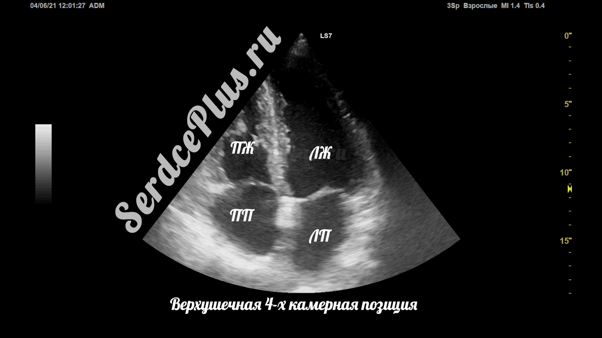 Сечения в эхокардиографии