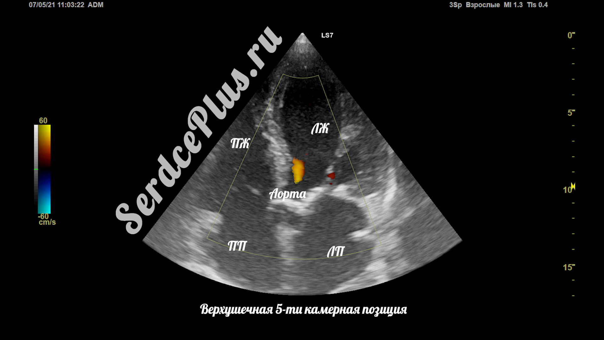 Сечения в эхокардиографии