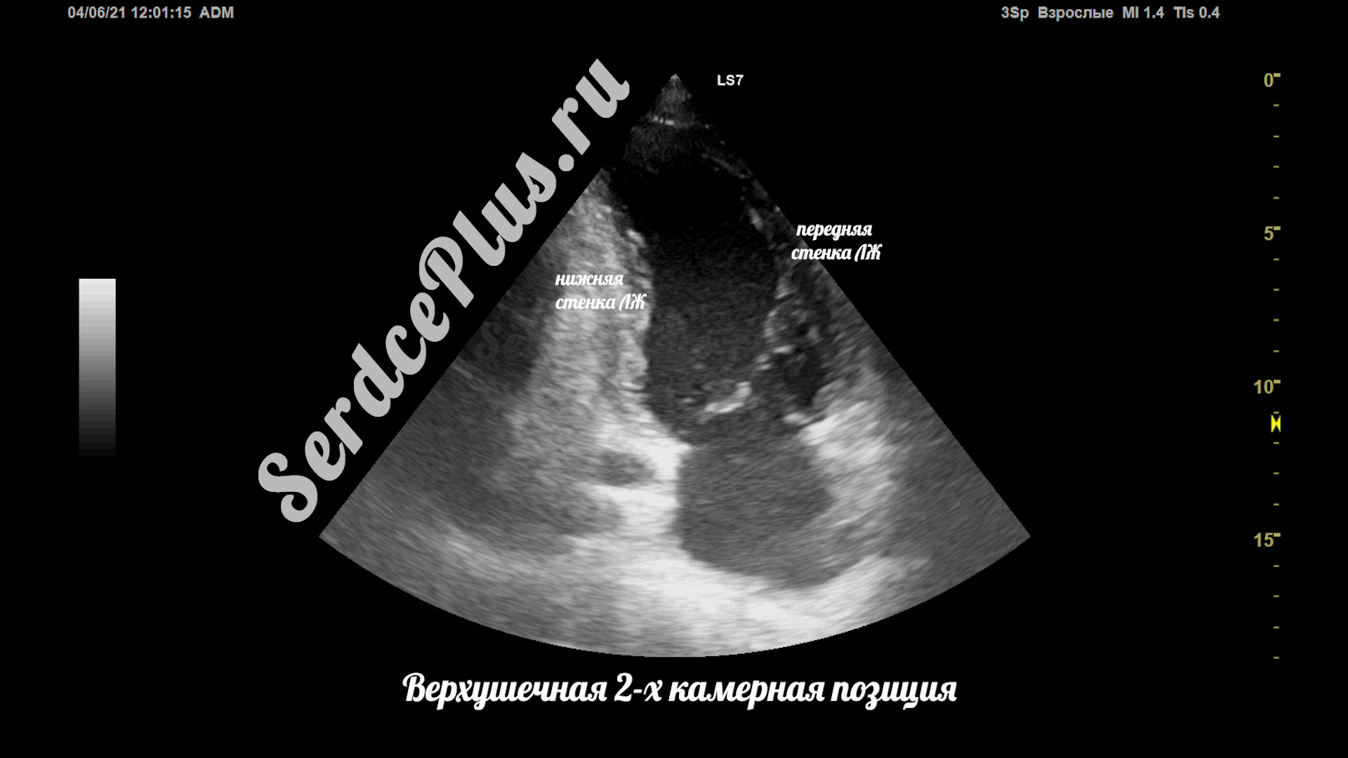 Сечения в эхокардиографии