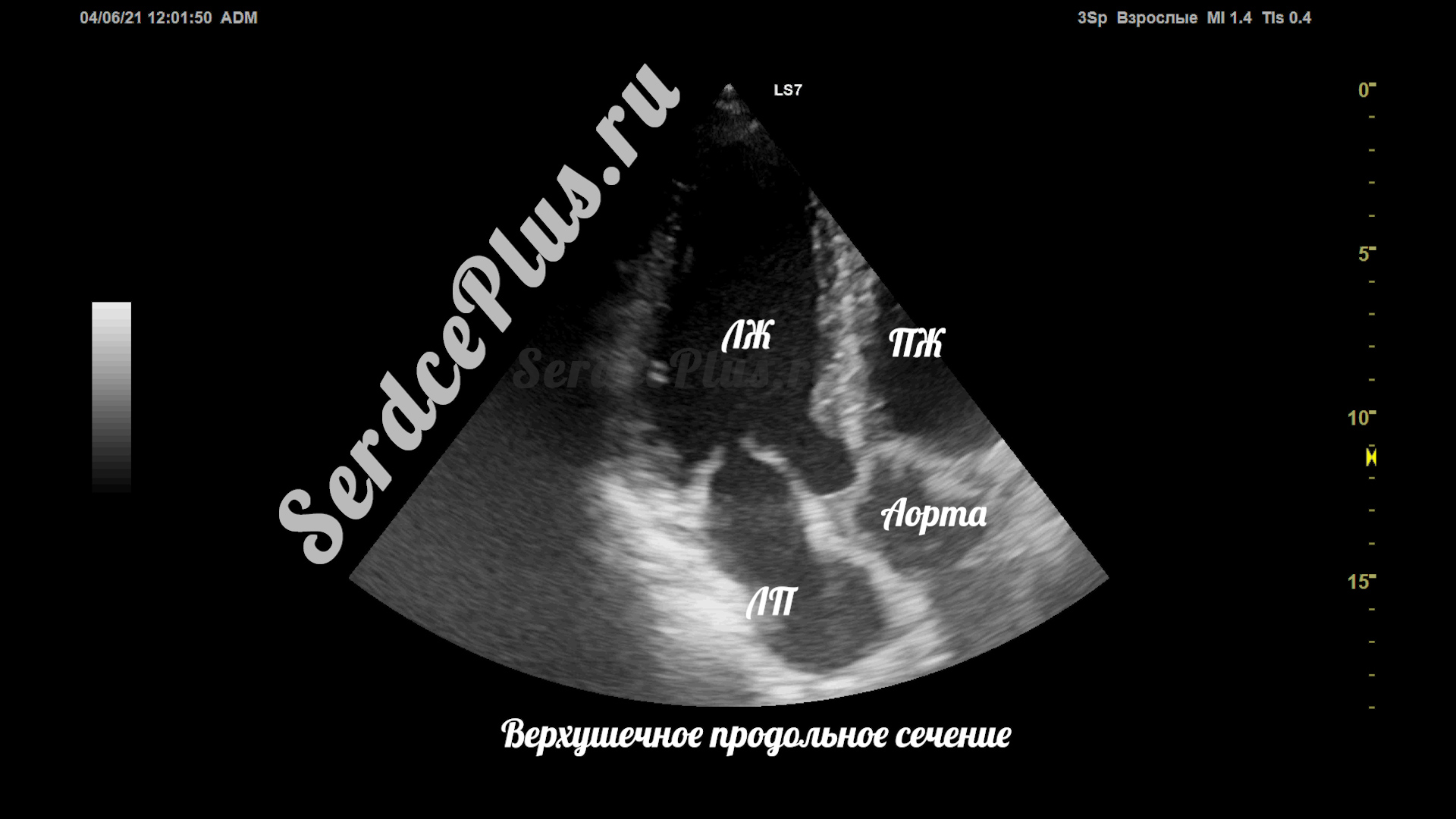 Сечения в эхокардиографии