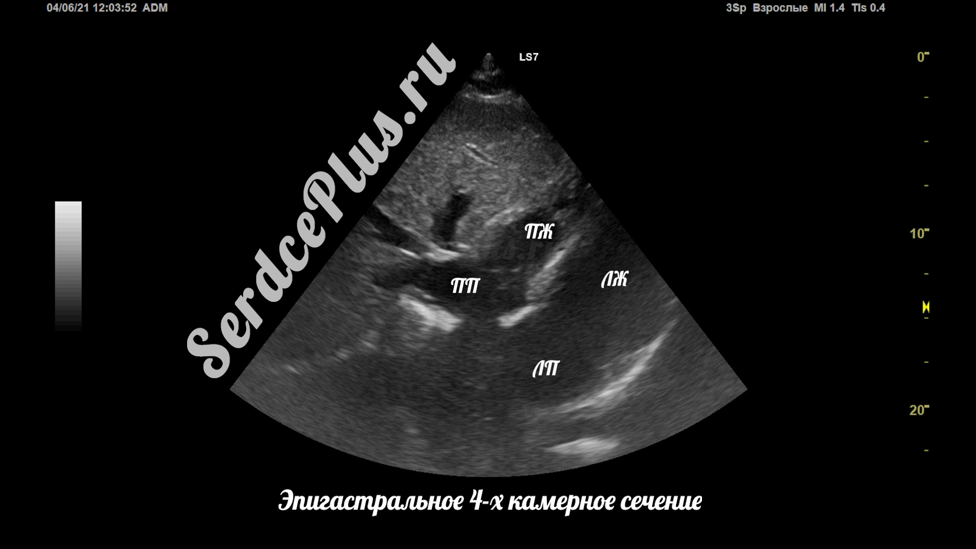 Сечения в эхокардиографии