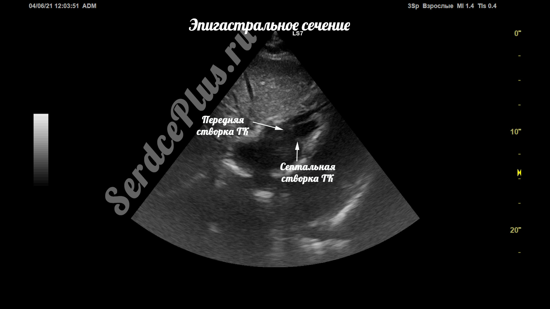 Створки трикуспидального клапана на эхокардиографии