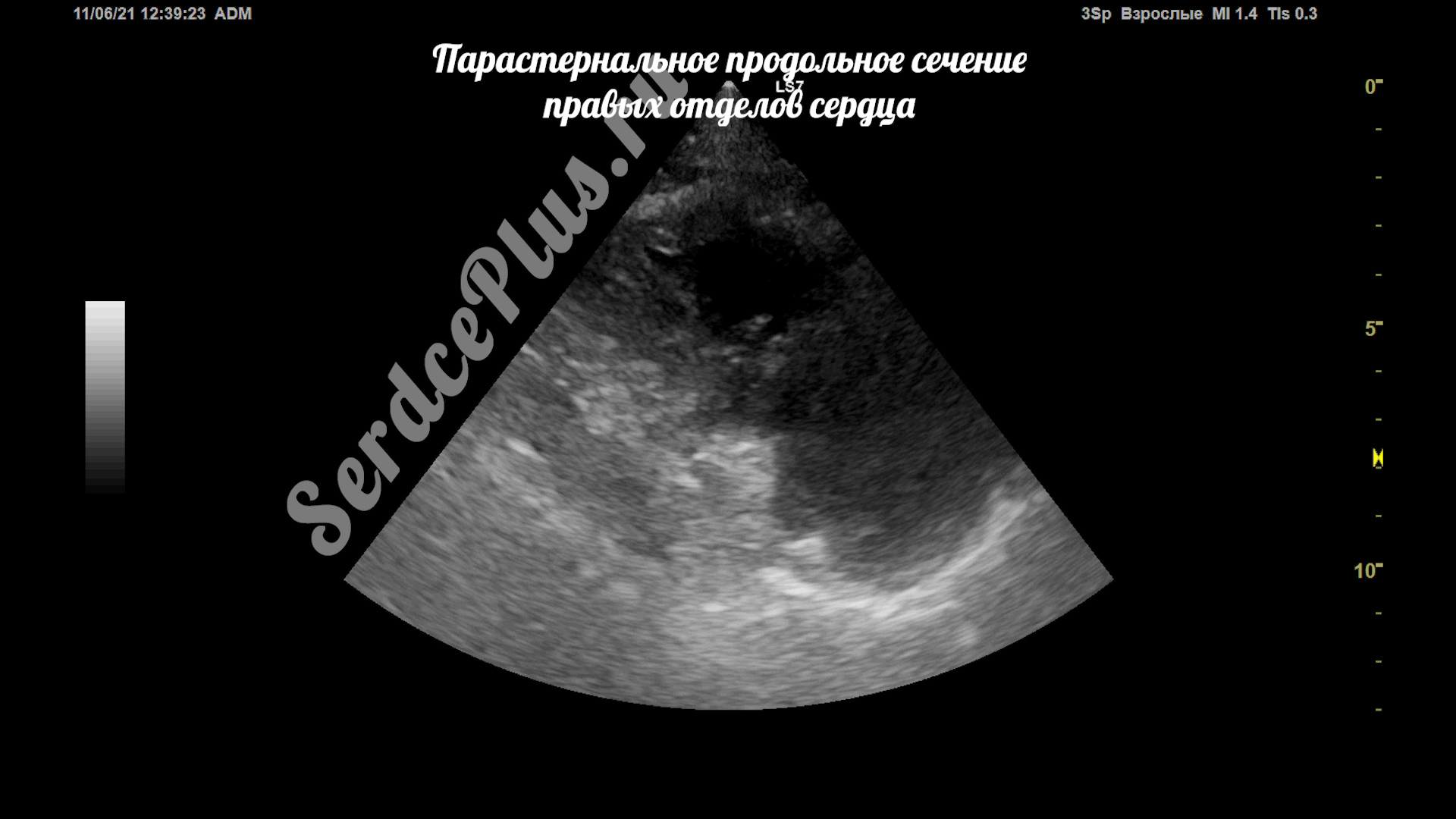 Створки трикуспидального клапана на эхокардиографии