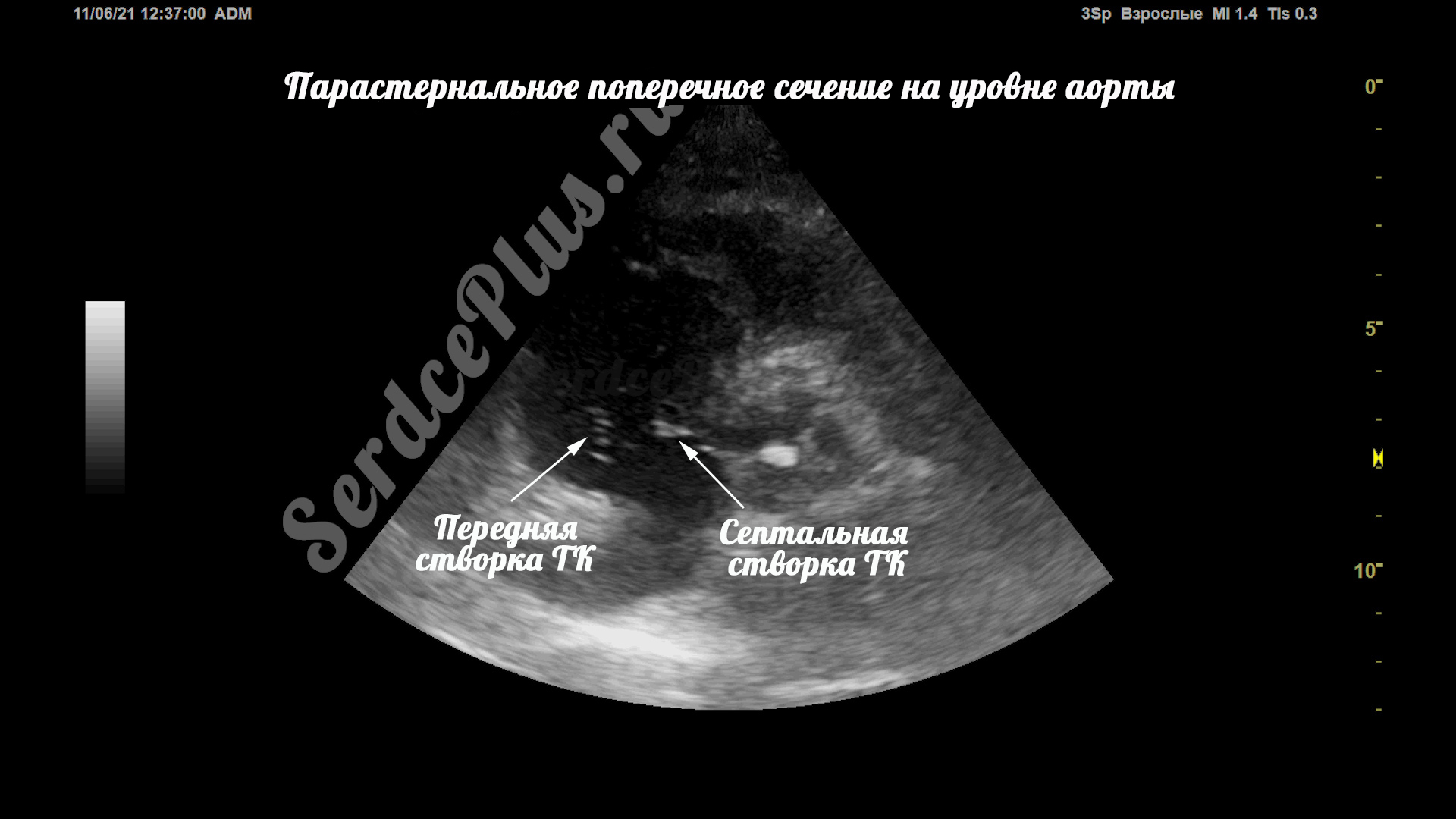 Створки трикуспидального клапана на эхокардиографии