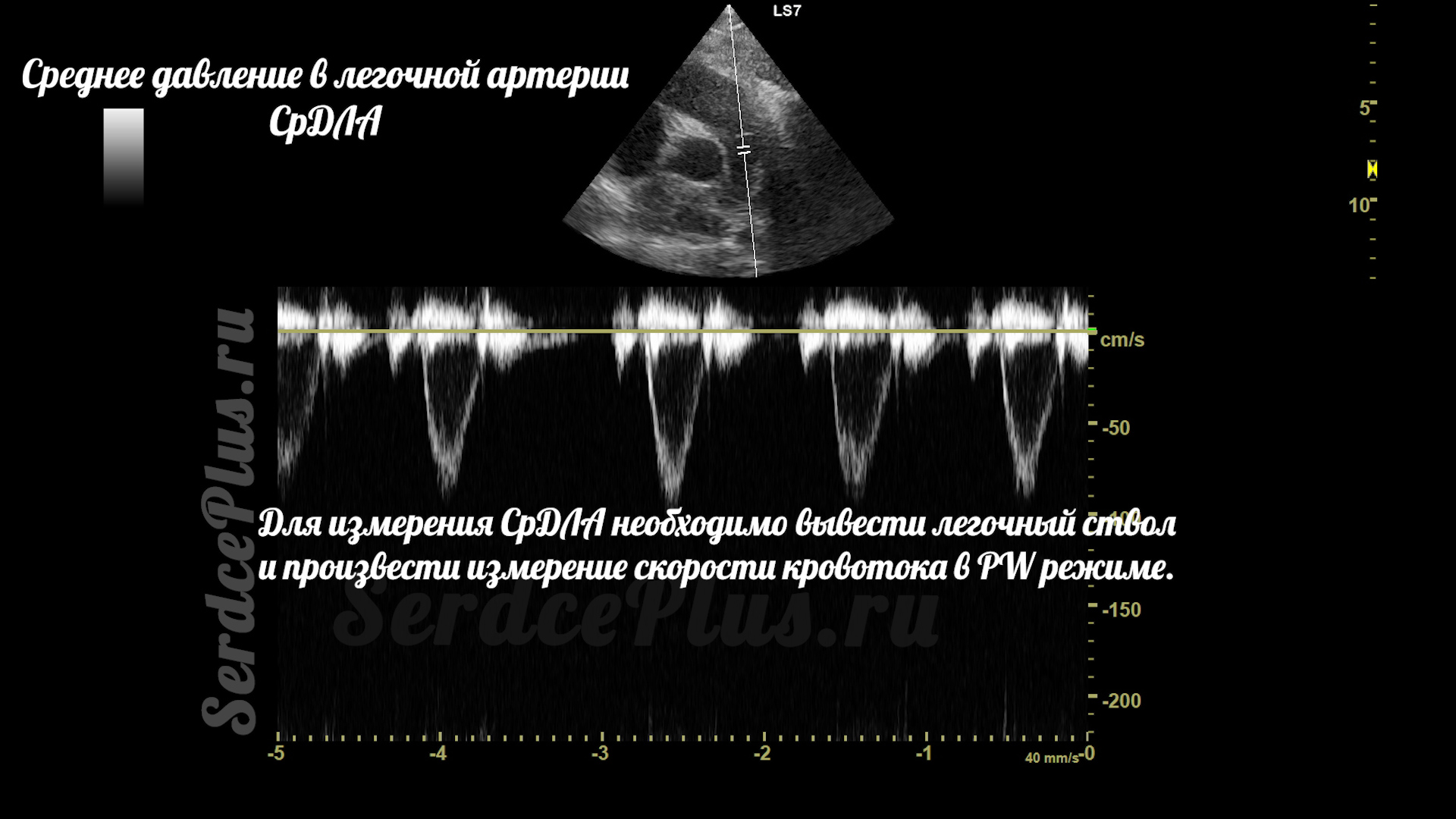 Измерение среднего и систолического давлений в легочной артерии на ЭхоКГ