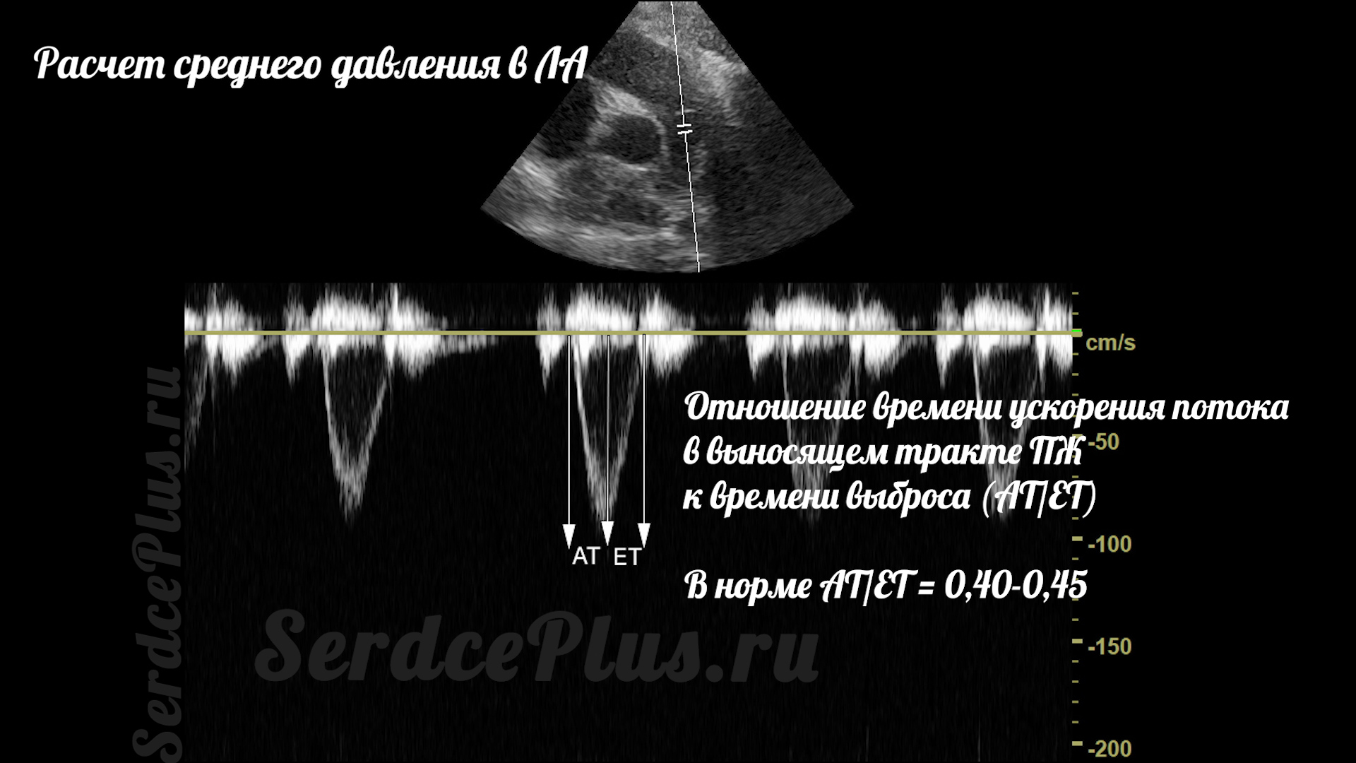 Измерение среднего и систолического давлений в легочной артерии на ЭхоКГ