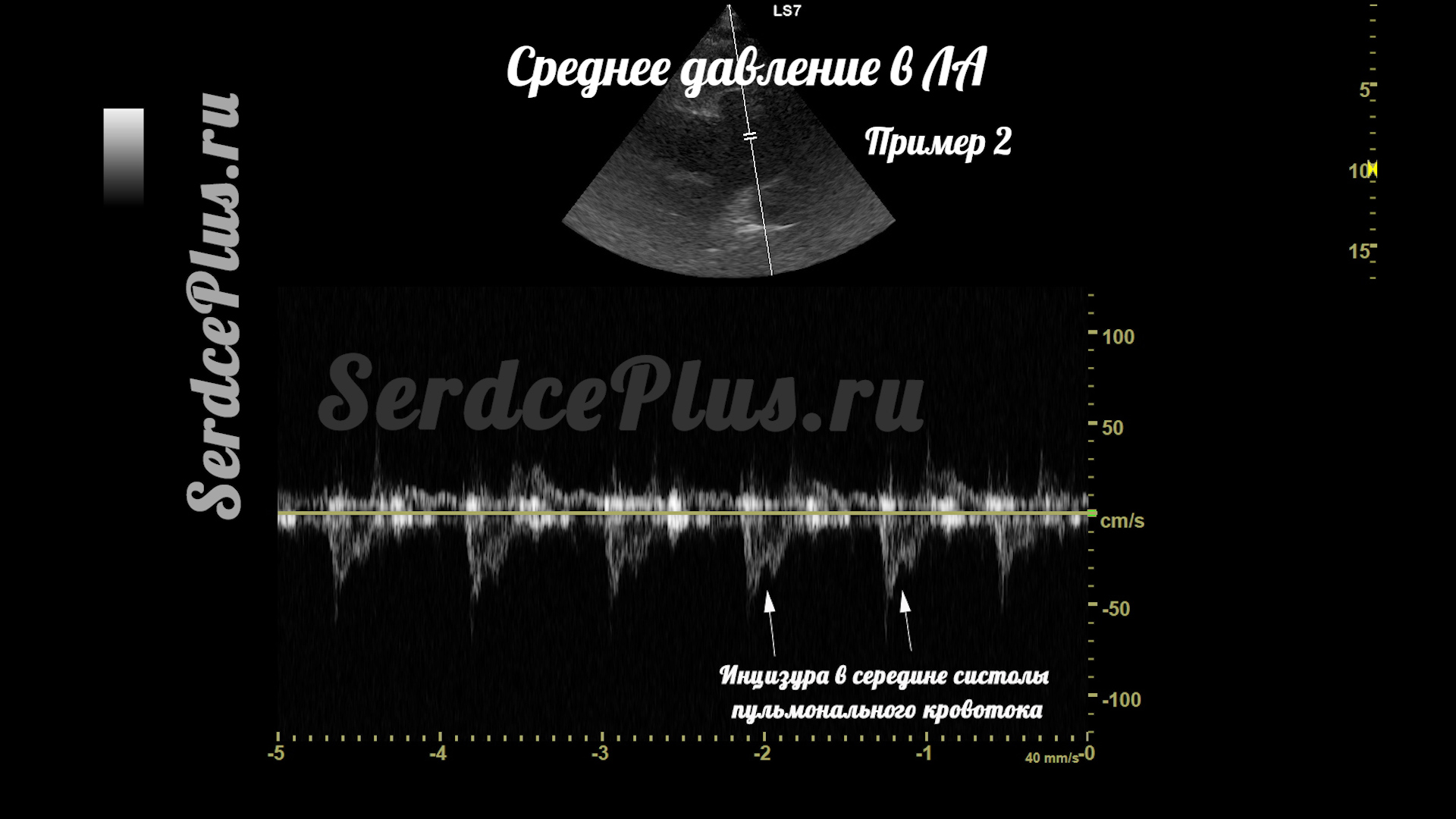Измерение среднего и систолического давлений в легочной артерии на ЭхоКГ
