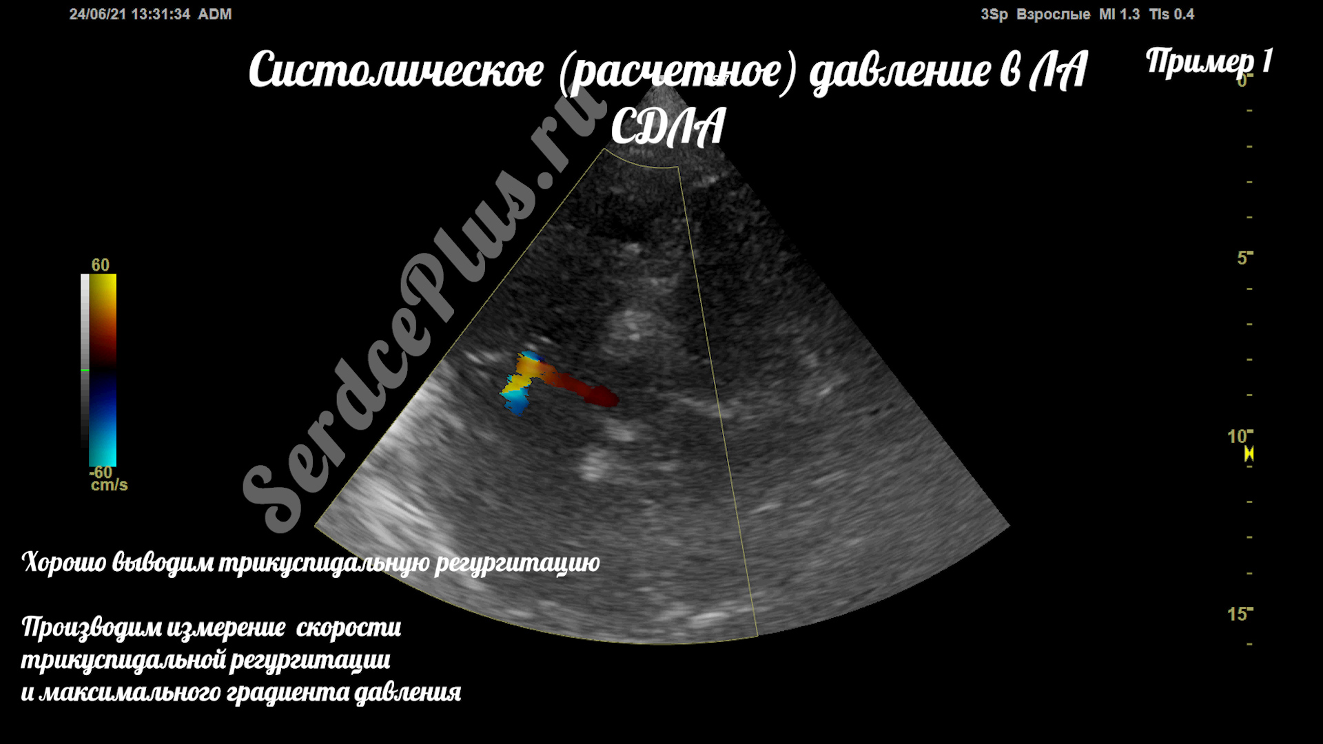 Измерение среднего и систолического давлений в легочной артерии на ЭхоКГ