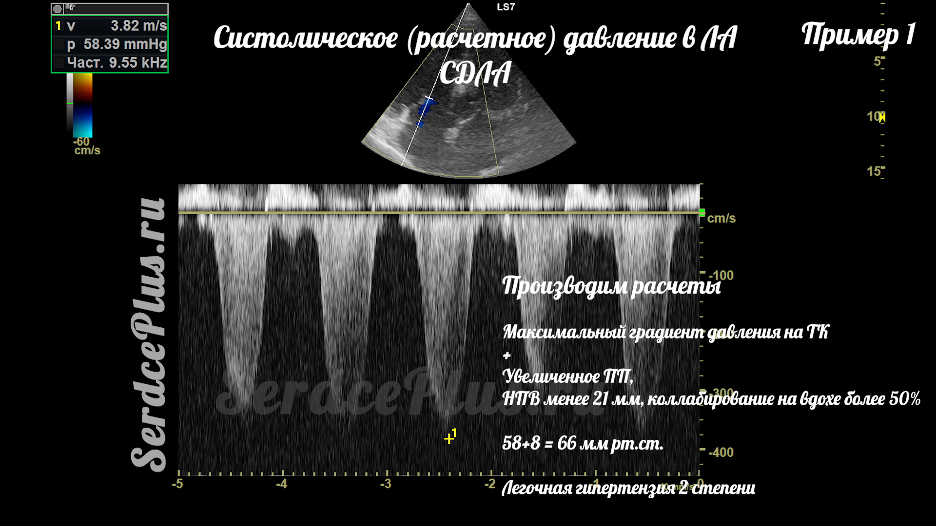 Измерение среднего и систолического давлений в легочной артерии на ЭхоКГ