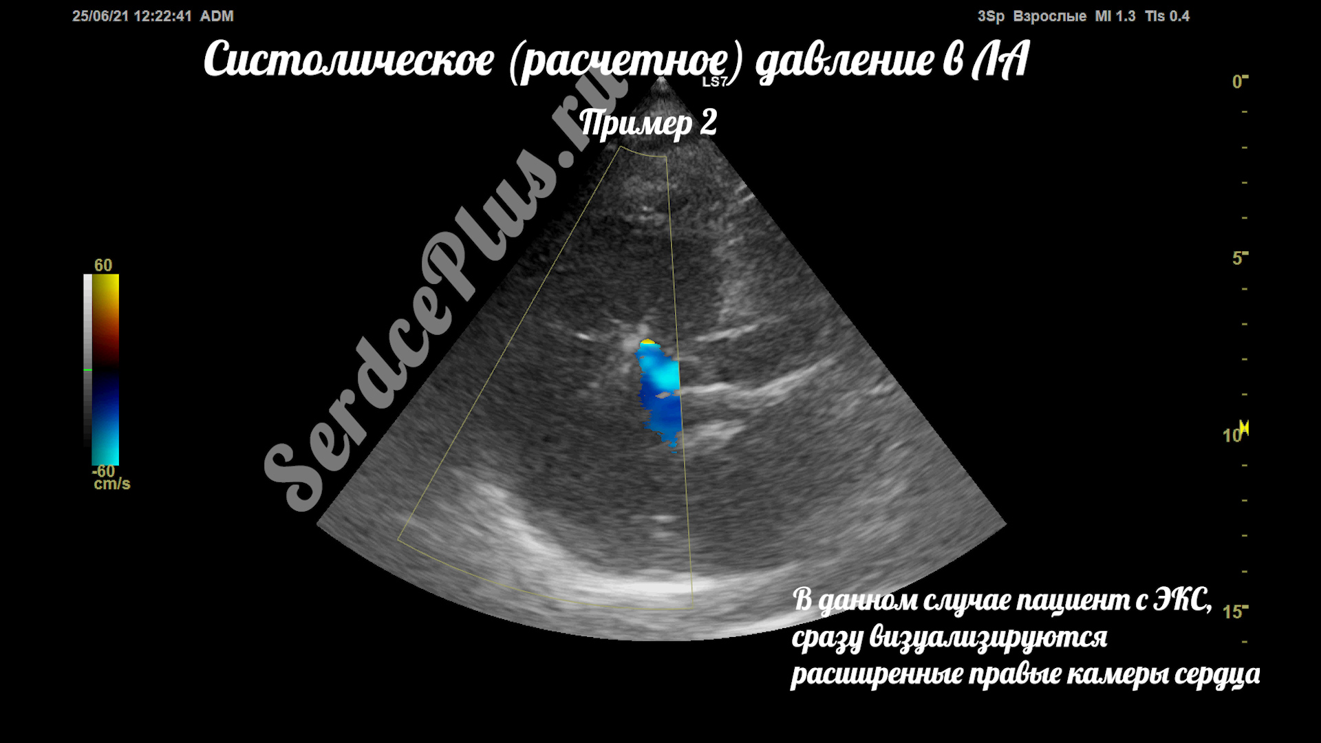 Измерение среднего и систолического давлений в легочной артерии на ЭхоКГ