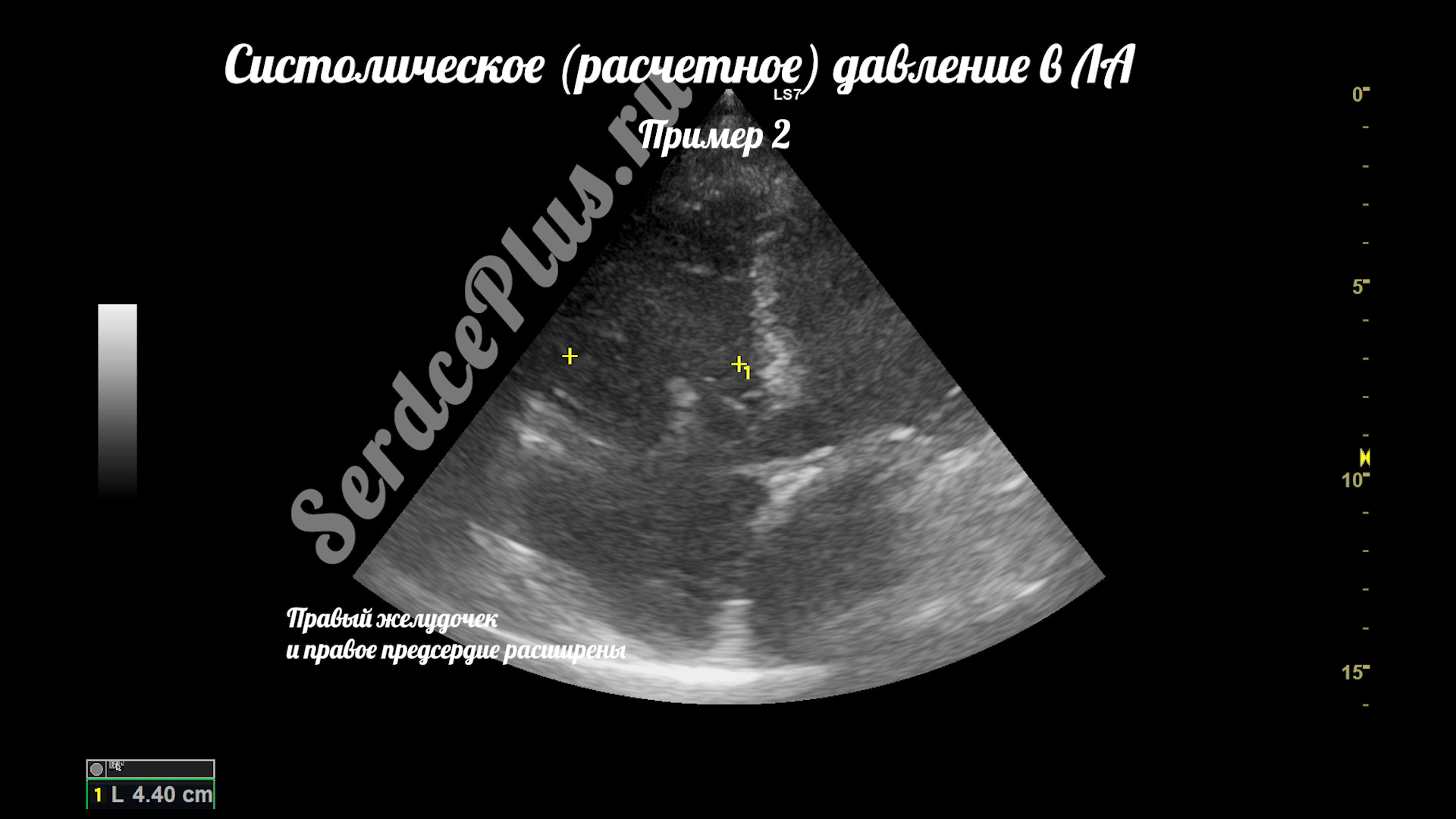 Измерение среднего и систолического давлений в легочной артерии на ЭхоКГ