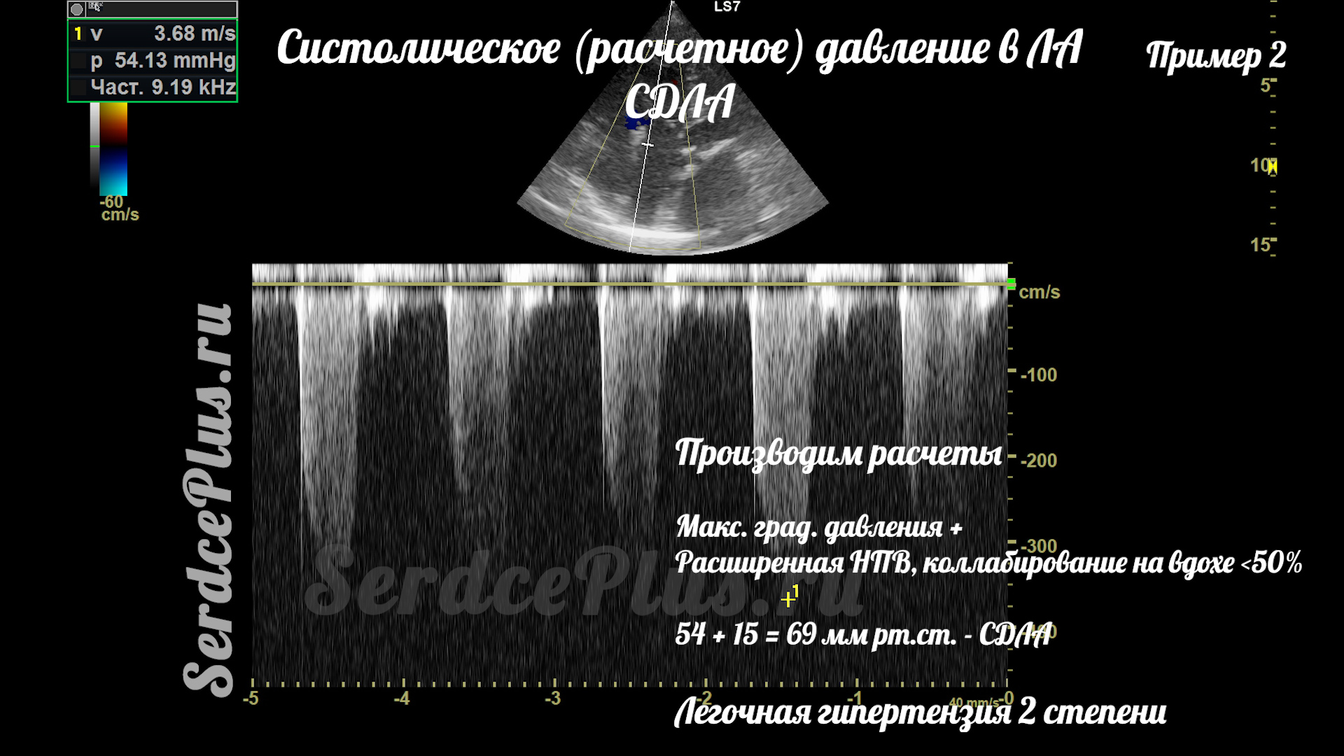 Измерение среднего и систолического давлений в легочной артерии на ЭхоКГ