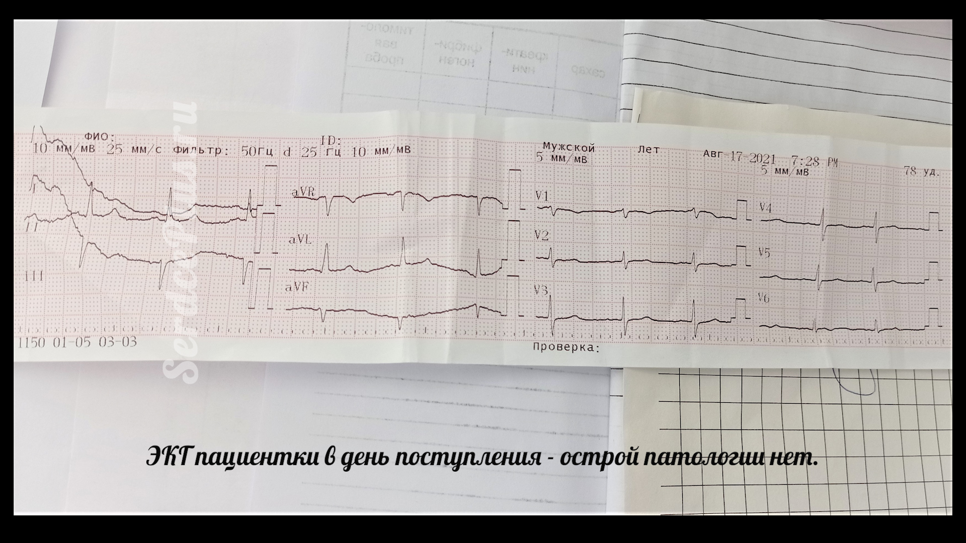 Инфаркт миокарда на эхокардиографии