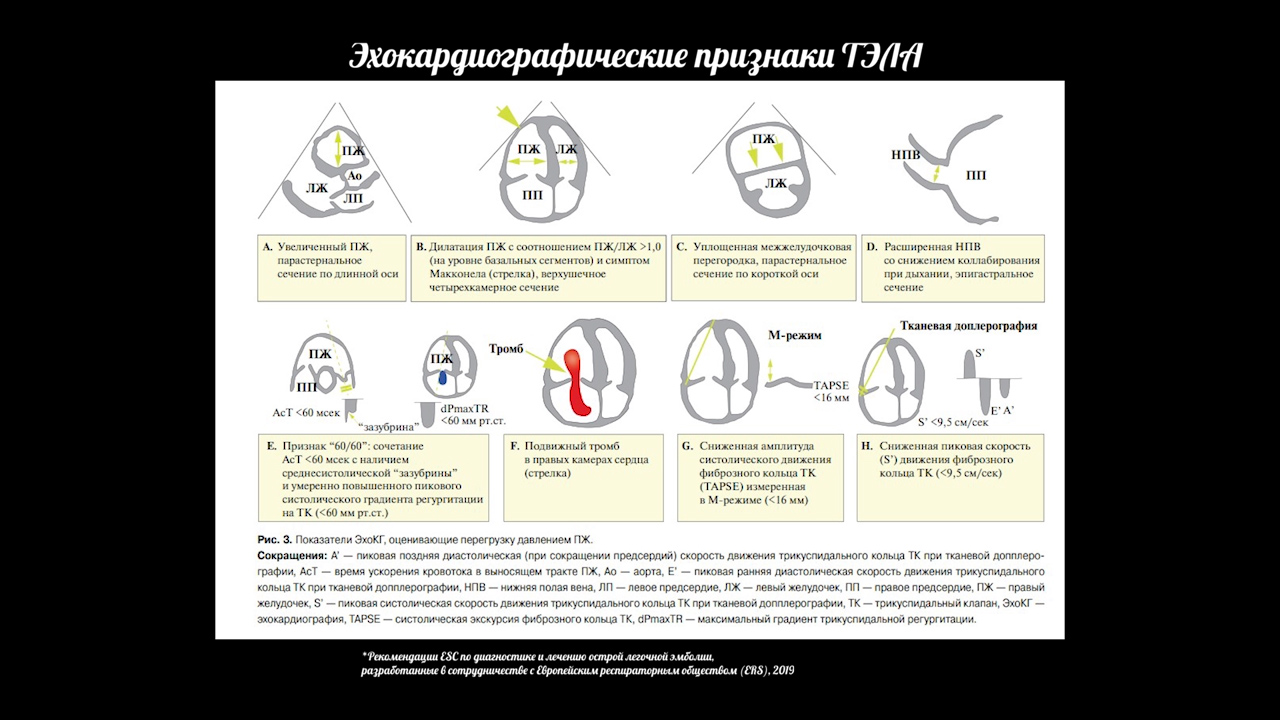 ТЭЛА на эхокардиографии