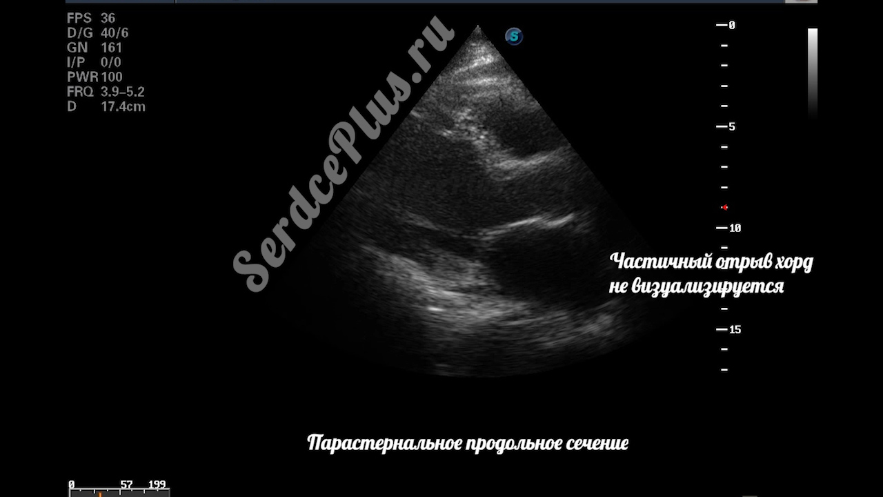 Частичный отрыв хорд задней створки митрального клапана