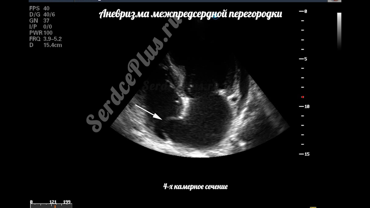 Аневризма межпердсердной перегородки с дефектом МПП