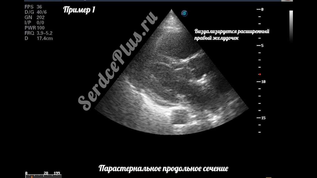 тромбоэмболия легочной артерии на эхокардиографии