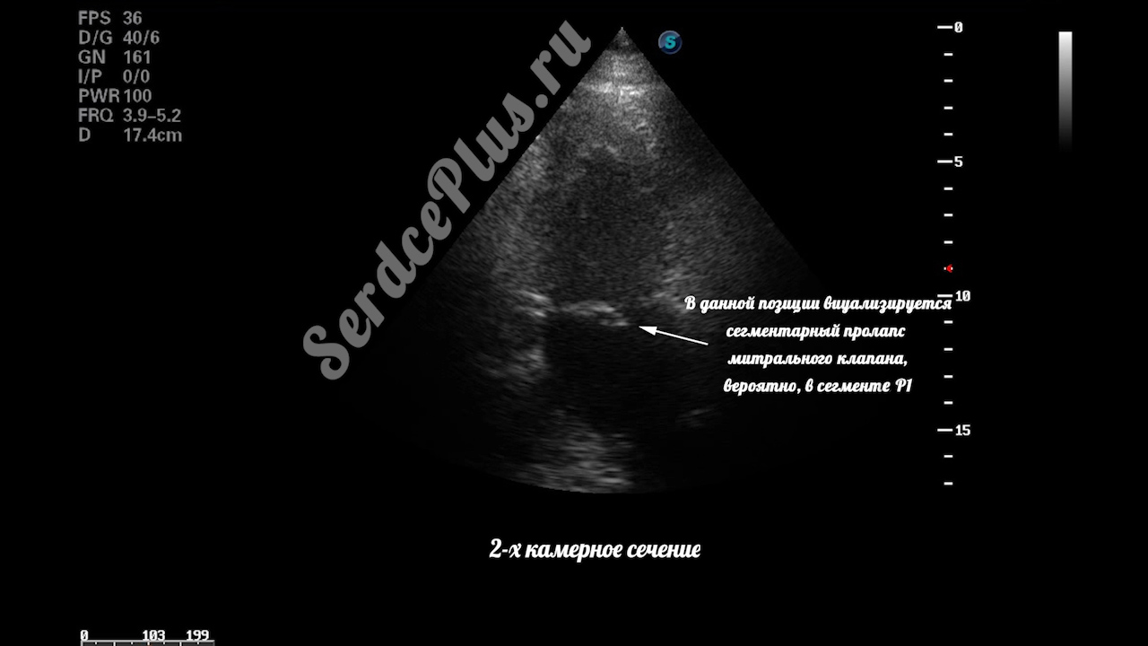 Частичный отрыв хорд задней створки митрального клапана