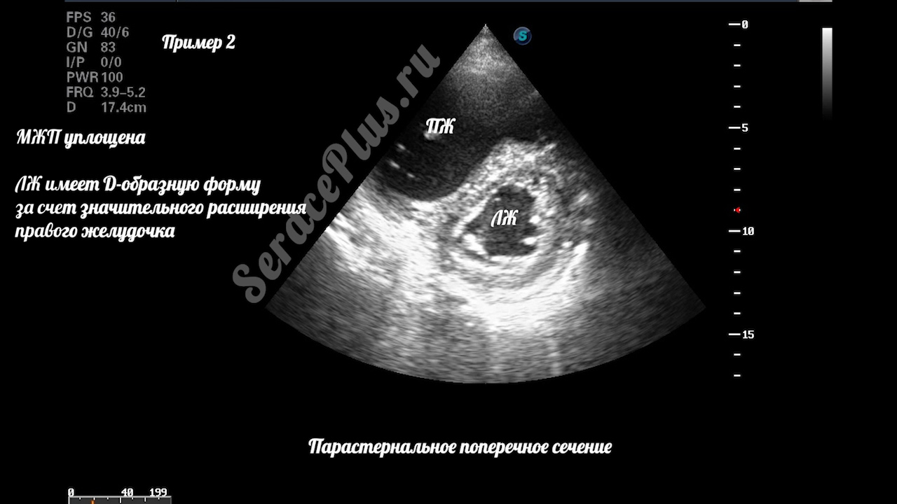 ТЭЛА на эхокардиографии