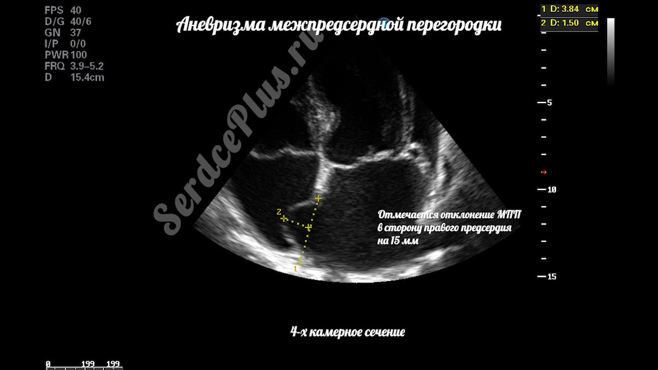 Аневризма межпердсердной перегородки с дефектом МПП