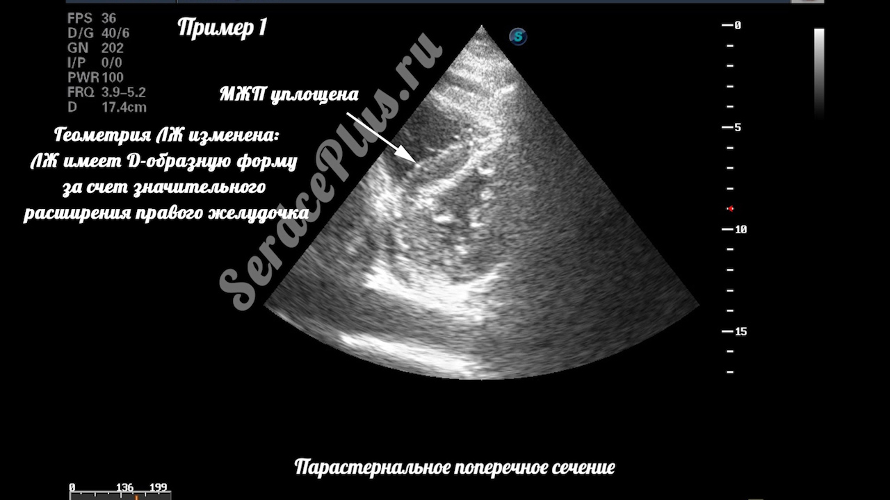 тромбоэмболия легочной артерии на эхокардиографии