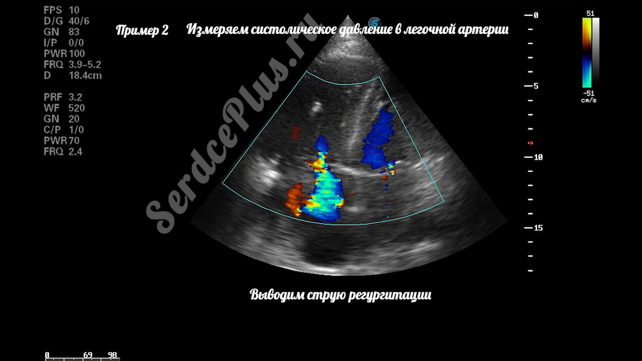 тромбоэмболия легочной артерии на эхокардиографии