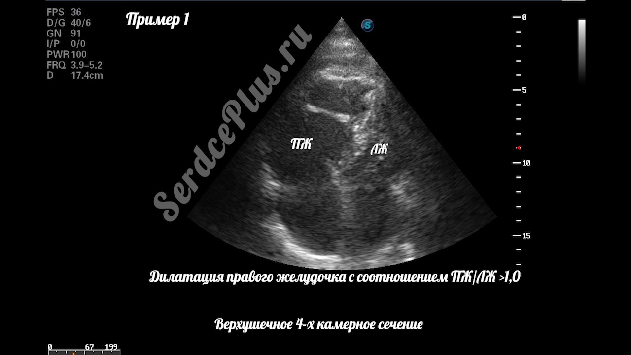 тромбоэмболия легочной артерии на эхокардиографии