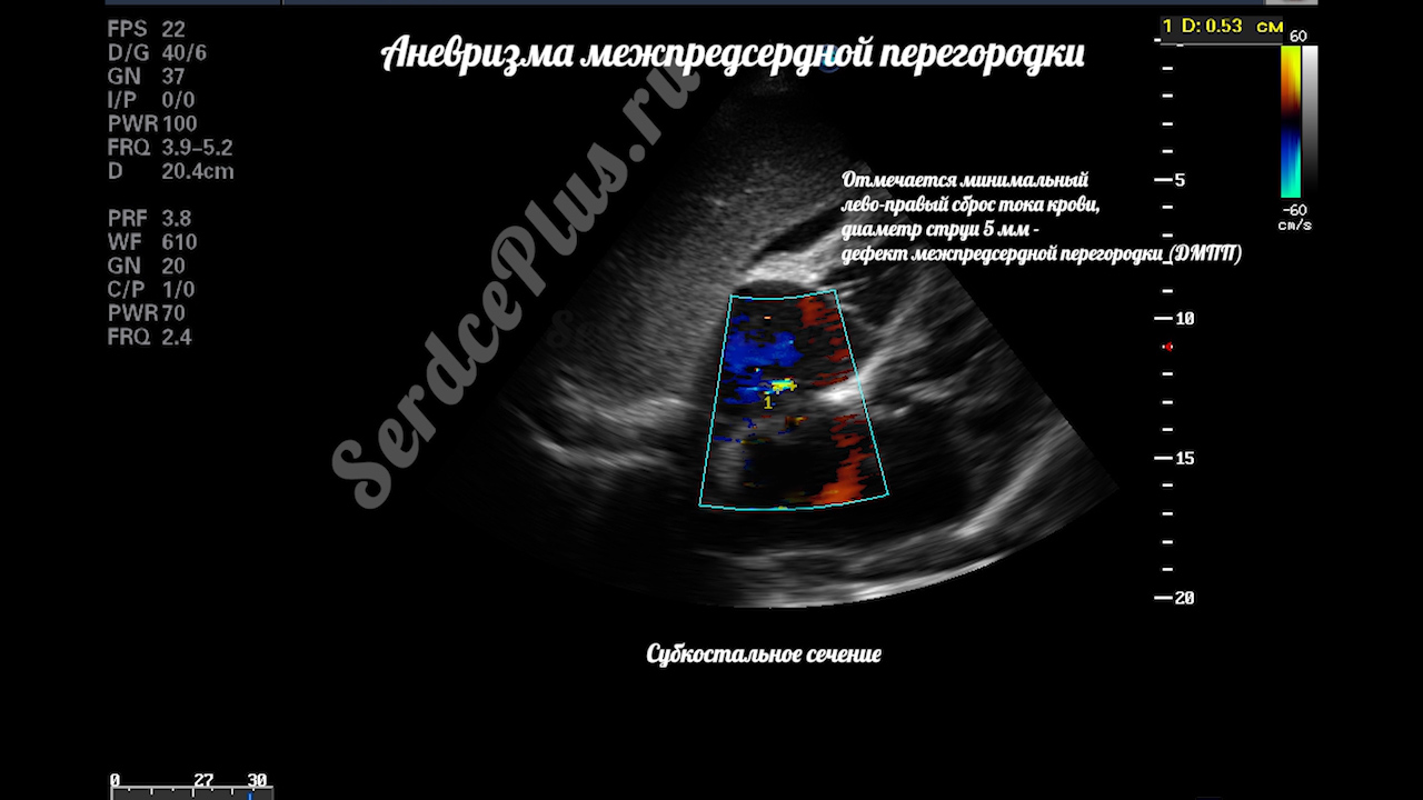 Аневризма межпердсердной перегородки с дефектом МПП