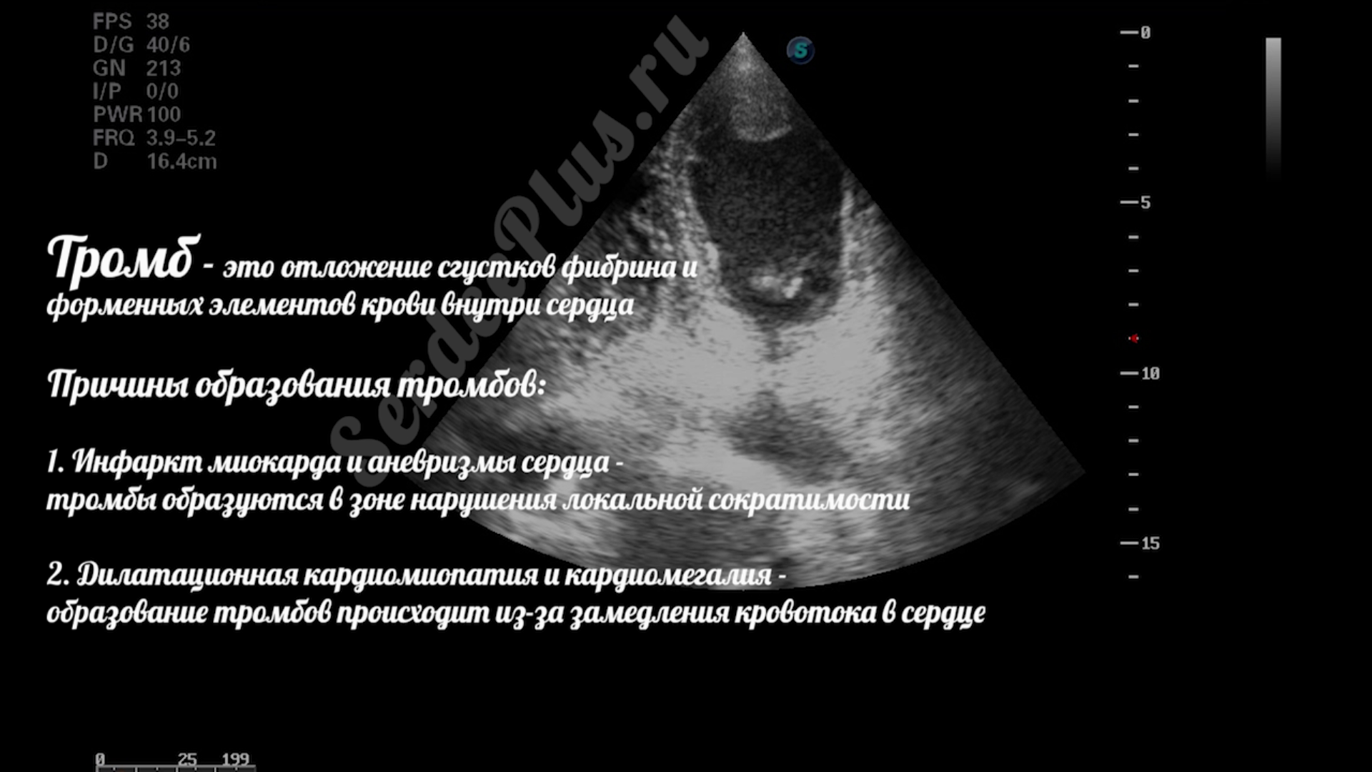 Тромб в верхушке левого желудочка после перенесенного инфаркта