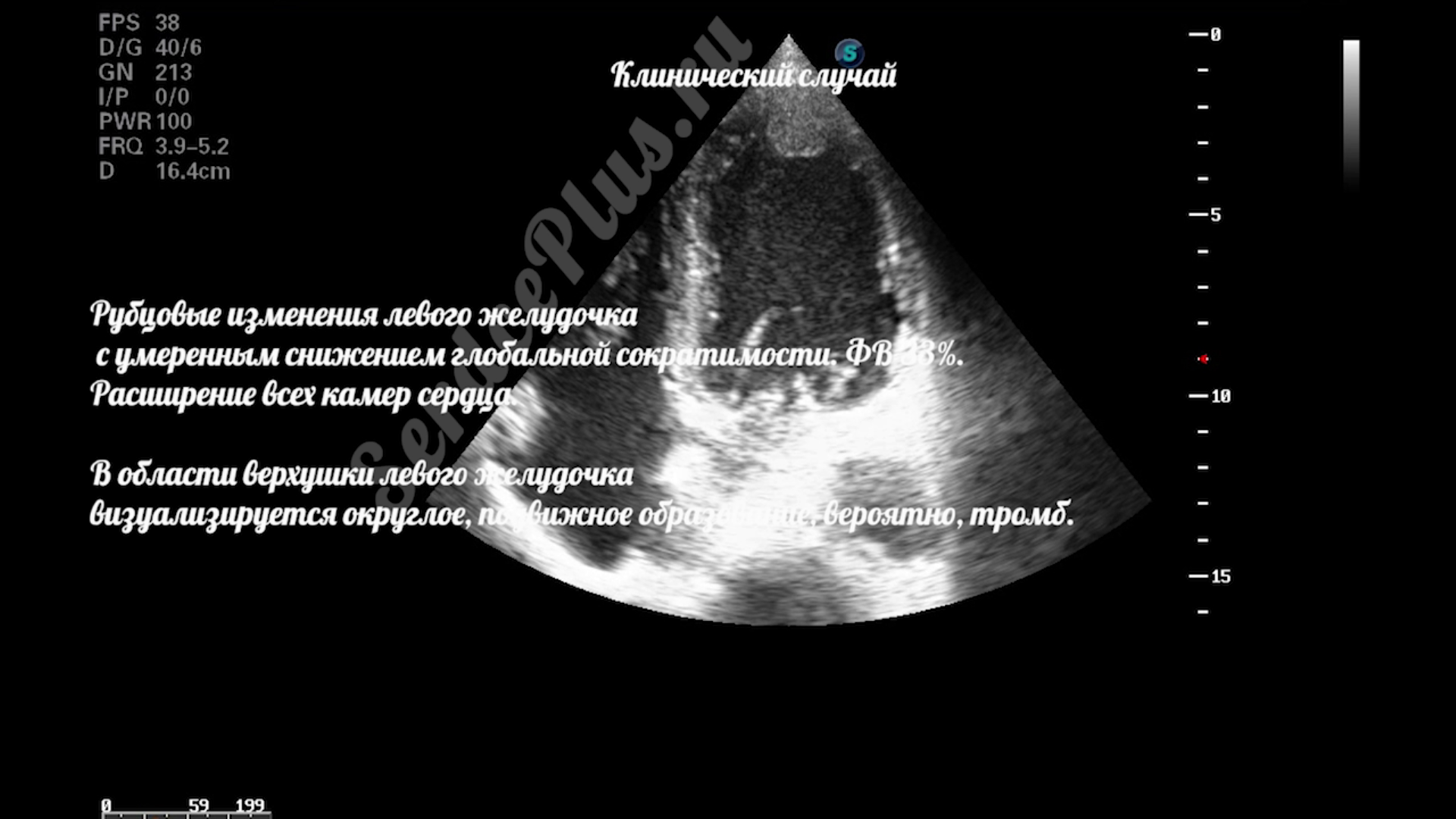 Тромб в верхушке левого желудочка после перенесенного инфаркта
