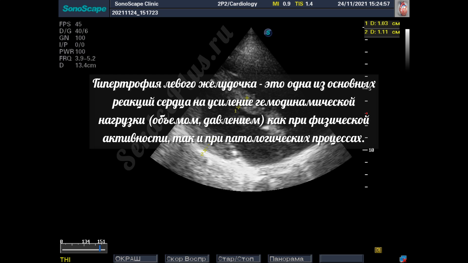 Гипертрофия левого желудочка. Заключение эхокардиографии